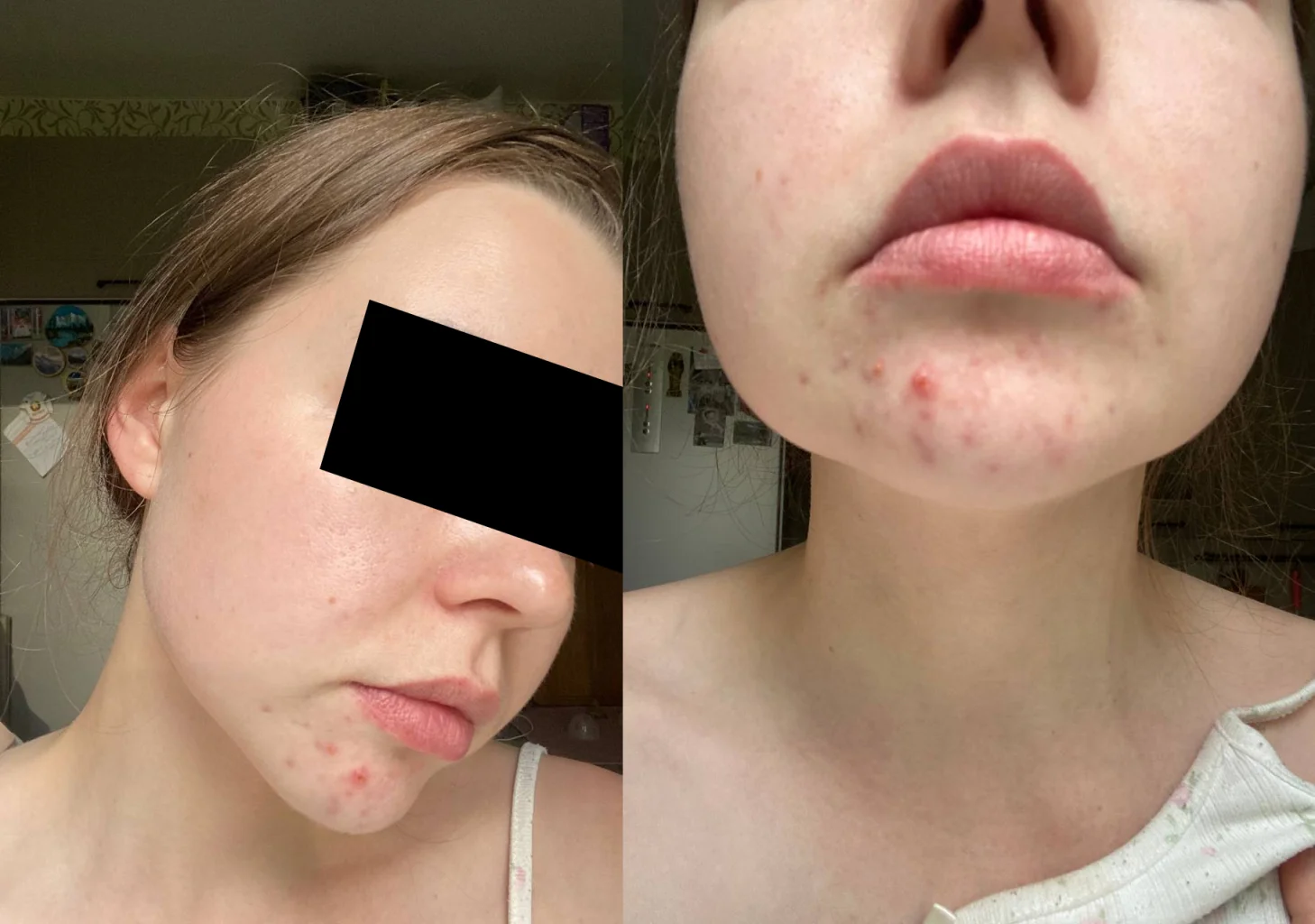 Лечение акне, фотоомоложение Lumecca, HydraFacial, BioRePeel, биоревитализация от акне